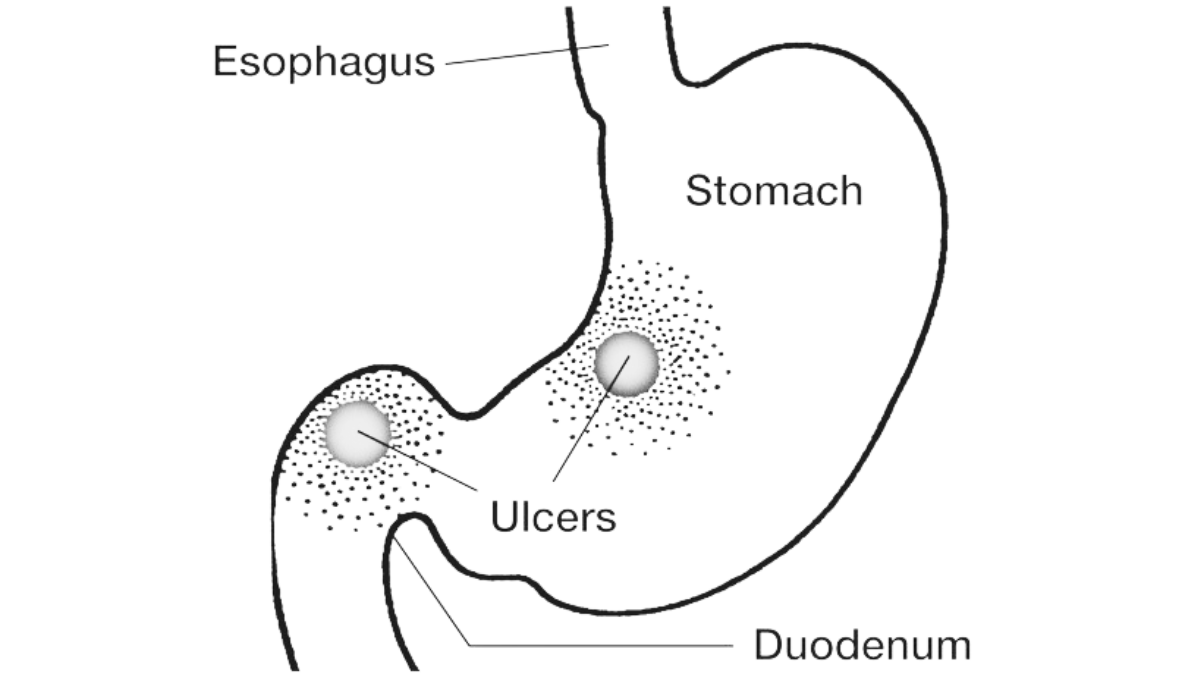 Healing Ulcers in Days with Cabbage Juice